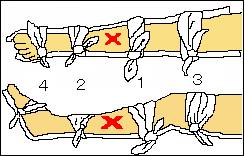 イラスト：下肢の固定2