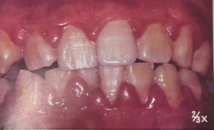 写真：炎症のある歯ぐき